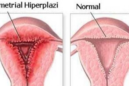 Rahim İç Tabakasında Kalınlaşma (Endometrial Hiperplazi)
