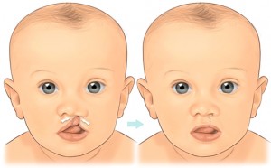Bebeklerde Yarık Dudak – Damak Ve Tedavisi