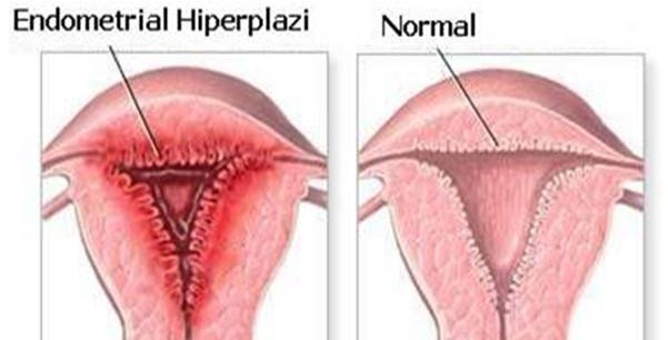 endometriyal hiperplazi ile yüksek tansiyon