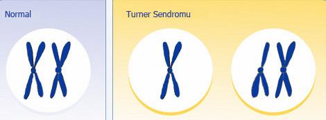 Turner Sendromu Özellikleri
